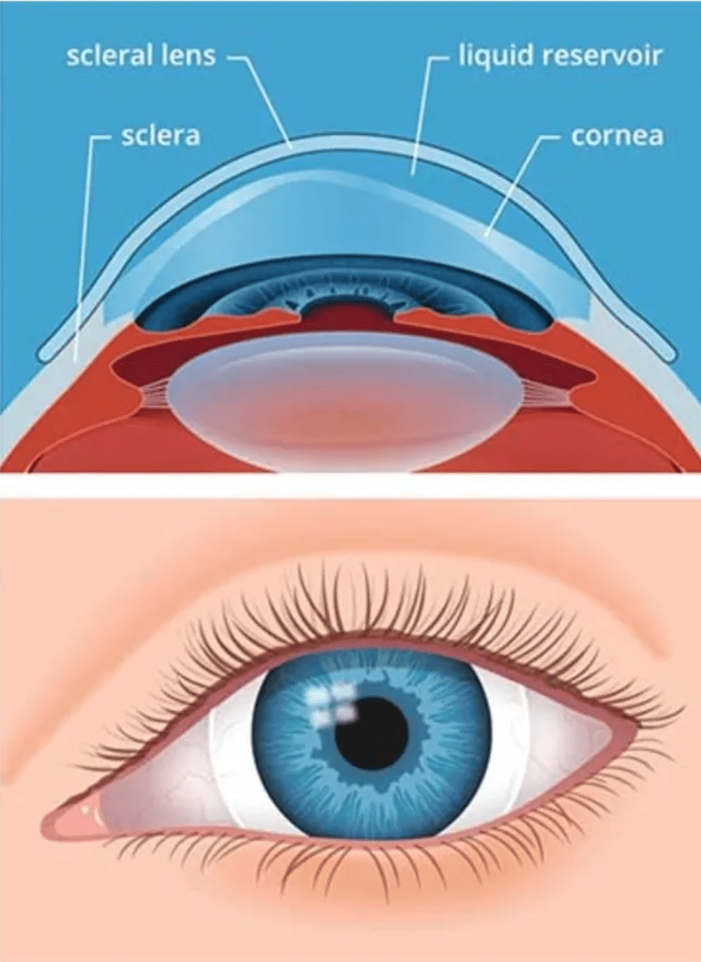 Why a New Pair of Scleral Lenses?